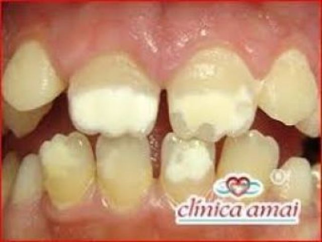 Causa cirrose hepática, além de diminuir a quantia de cálcio nos dentes e ossos.