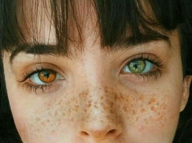 Heterocromia