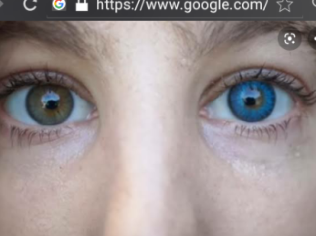 Heterocromia