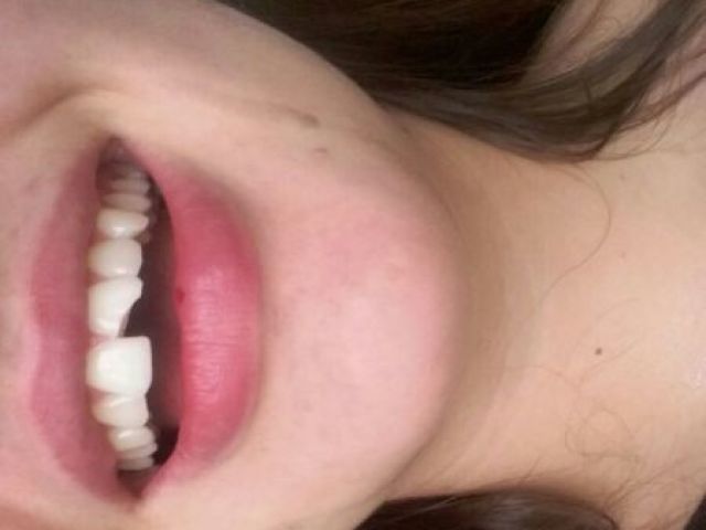 Dente quebrado