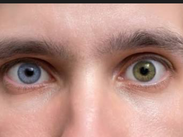 Heterocromia