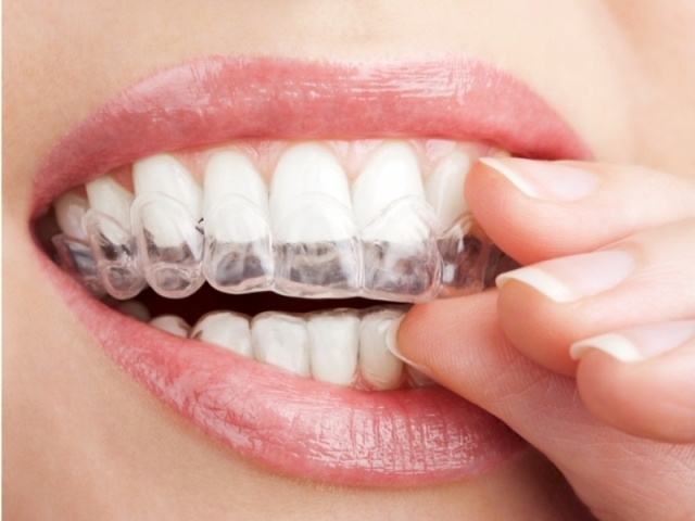 Placa Invisalign