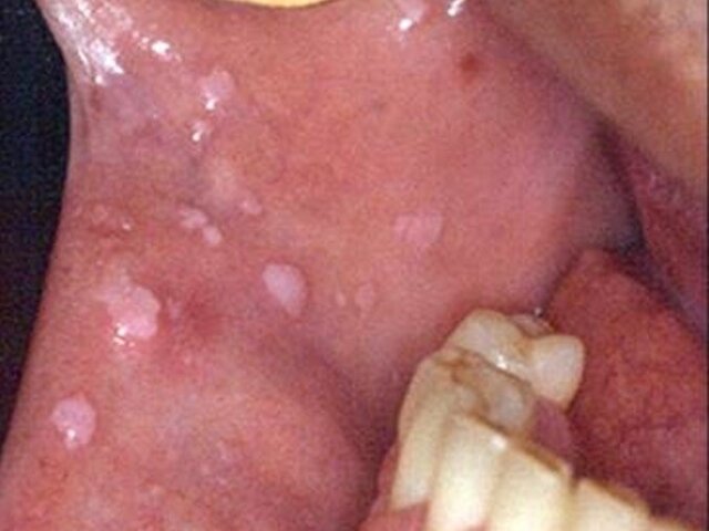 O principal responsável pela maior porcentagem de câncer oral hoje em dia é o HPV.