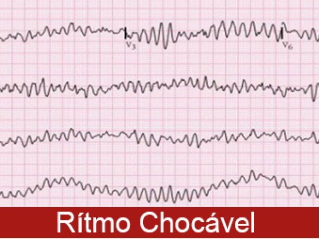 Fibrilação Ventricular (FV)