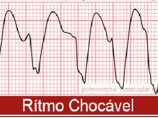 Taquicardia Ventricular sem Pulso (TVSP)