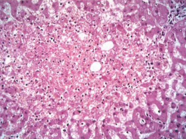 Imagen microscópica que muestra necrosis hepática centrolobulillar con hemorragia y células inflamatorias aisladas.