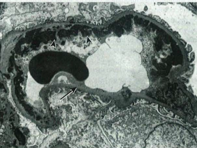 Microfotografía electrónica de un asa capilar glomerular renal de un paciente con nefritis por LES.
Los depósitos subendote liales densos (puntas de flechas) en la membrana basal (flecha) corresponden a «asas de alambre» observadas con microscopia óptica.