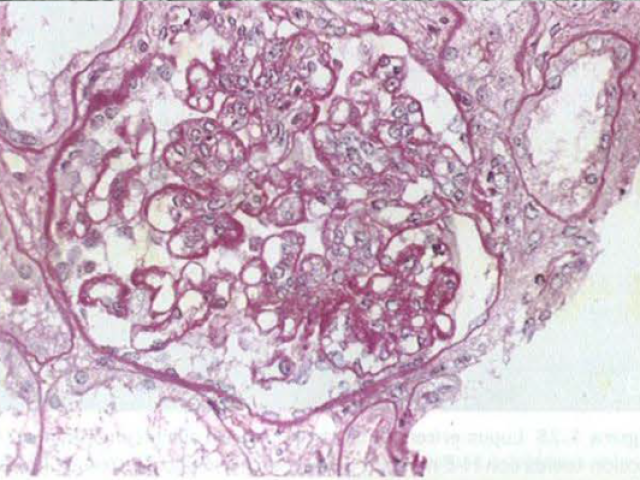 Nefritis lúpica mostrando un glomérulo con varias lesiones en «asa de alambre» que representan depósitos subendoteliales extensos de
inmunocomplejos