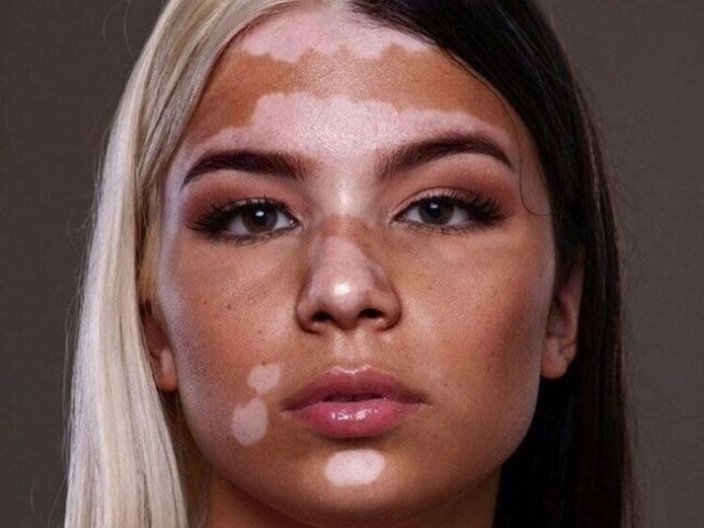 Vitiligo