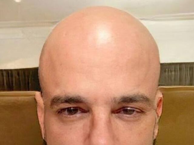 Careca (NAO É TOTALMENTE CARECA É AQUELES CABELO NA RÉGUA TIPO O ROD)