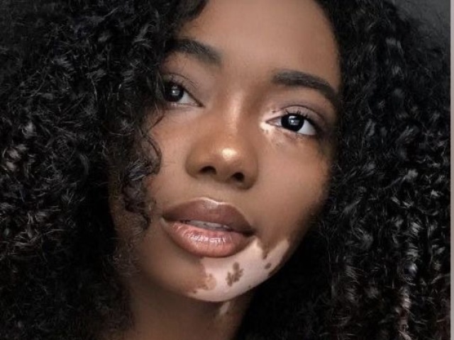 Vitiligo (Deusa 😩💖