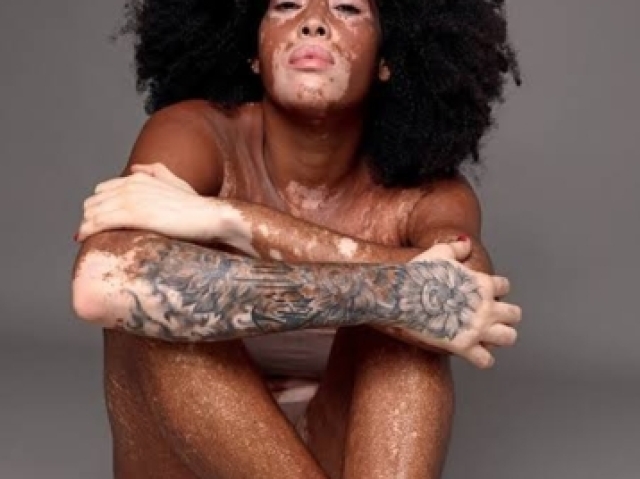 Vitiligo pft☆☆