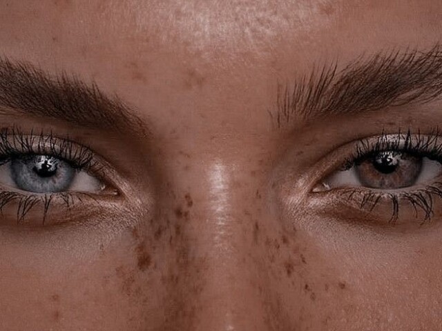 Heterocromia