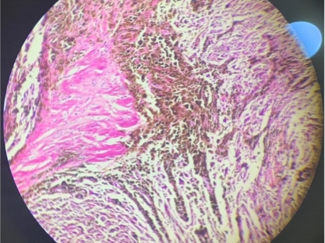 Organo: Piel
Proceso: Acumulacion Pigmento Endógeno
Descripcion: Acumulacion de pigmento 
marron en la dermis reticular (profunda).
Dx: Melanoma