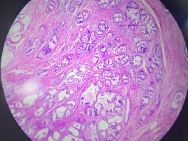 Organo: Pulmon
Proceso: Necrose Caseosa
Descripcion: Necrose Caseosa ao centro, 
células Gigantes de Langhans 
"Granuloma", células epiteloides
(macrófagos), coroa linfocitaria y 
fibroblasto. 
Dx: Tuberculosis