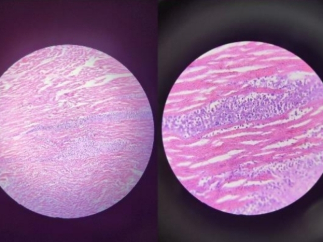 Organo: Corazon
Proceso: Adaptacion Hipertrofia
Descripcion: Miocardiocitos aumentados de
tamanho, aumento de lo espacio intersticial,
proliferação de fibroblasto y pigmento de
lipofuscina
Dx: Hipertrofia Cardíaca
