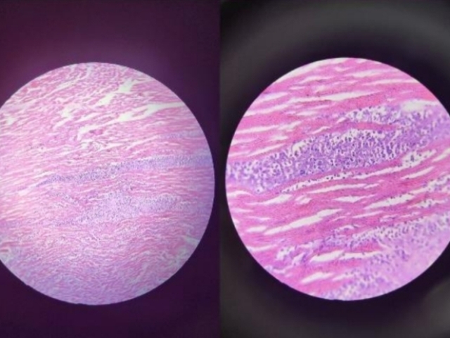 Organo: Corazon
Proceso: Adaptacion Hipertrofia 
Descripcion: Miocardiocitos aumentados de 
tamanho, aumento de lo espacio intersticial, 
proliferação de fibroblasto y pigmento de 
lipofuscina
Dx: Hipertrofia Cardíaca