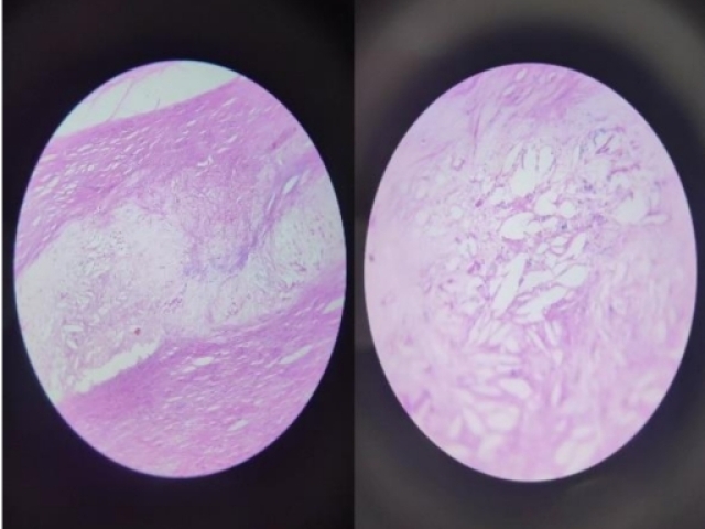 Organo: Vaso Sanguíneo
Proceso: Acumulacion Crônica
Descripcion: Cristales de colesterol entre as 
túnicas intima e média
Dx: Aterosclerosis