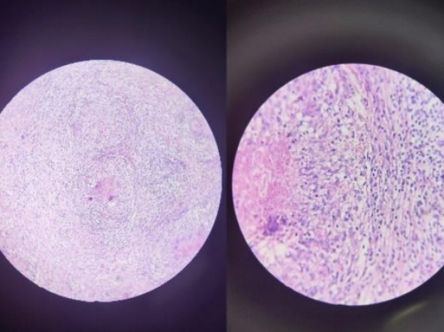 Organo: Corazon
Proceso: Necrose Coagulativa Isquêmica
Descripcion: Miocárdiocitos anucleados por
cariolosis, infiltrado de PMN (neutrófilos) y
hemorragia
Dx: IAM