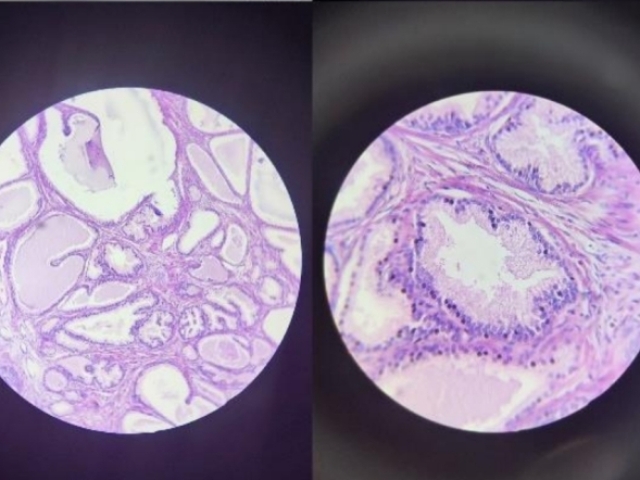 Organo: Esôfago
Proceso: Adaptacion Metaplasia
Descripcion: Cambio del epitélio escamoso
(plano estratificado não queratinizado) a
epitelio cilindrico simples com células
caliciformes.
Dx: Esôfago de Barret