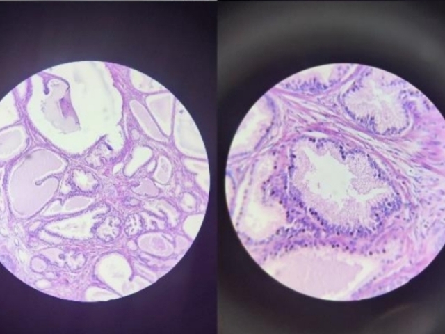 Organo: Esôfago 
Proceso: Adaptacion Metaplasia 
Descripcion: Cambio del epitélio escamoso
(plano estratificado não queratinizado) a 
epitelio cilindrico simples com células 
caliciformes.
Dx: Esôfago de Barret