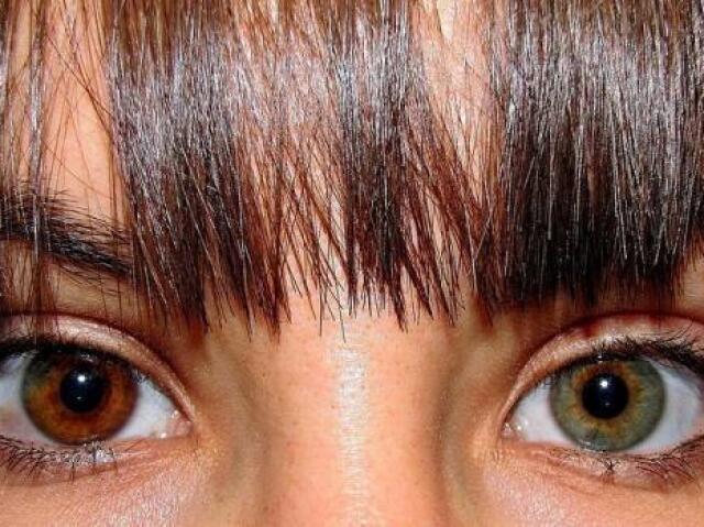 Heterocromia (verde e castanho).