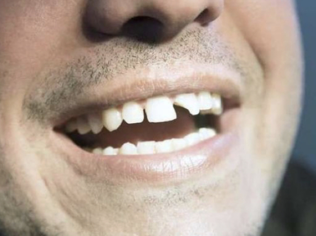 Quebrei meus dentes 4 vezes