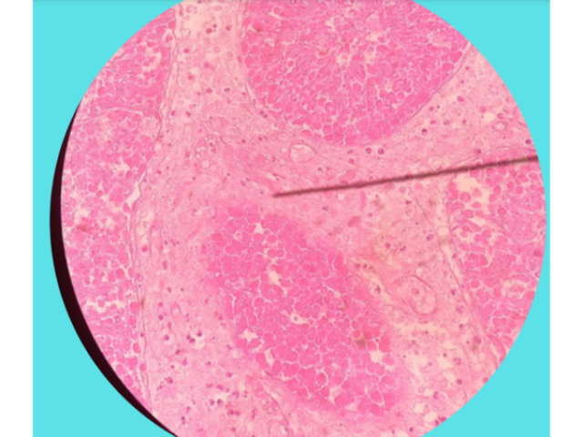 Descrição: Fígado apresentando vasos
ingurgitados, repletos de hemácias organizadas e
bem delimitadas.
Diagnóstico morfológico: Hiperemia hepática.