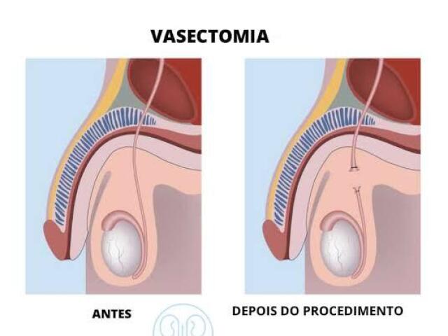 Vasectomia